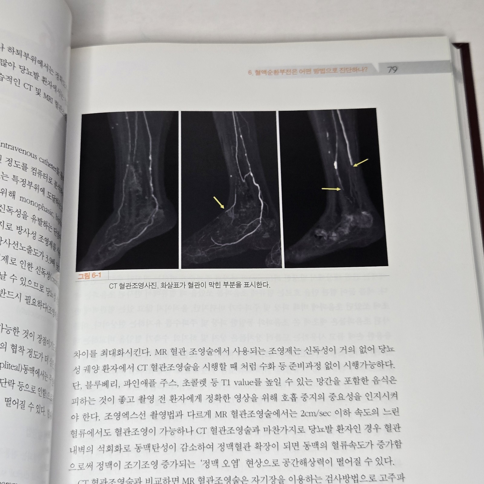 당뇨성 창상의 이해와 치료 (Management of Diabetic Wound) by Han Seung-kyu (한승규) 2008 Korean