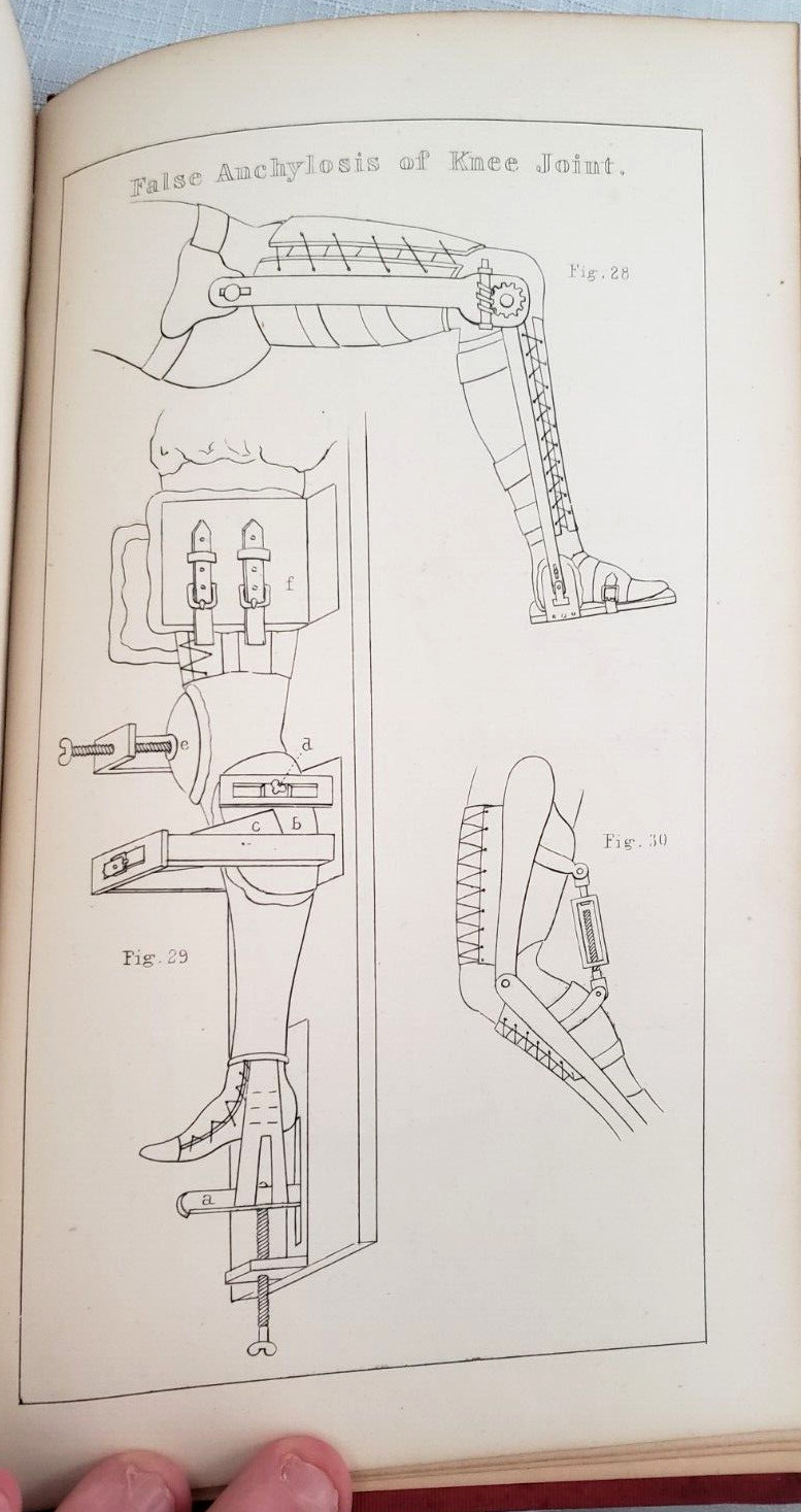 1845 1st,Bigelow MANUAL OF ORTHOPEDIC SURGERY,Harvard Medical Prize, MANY PLATES
